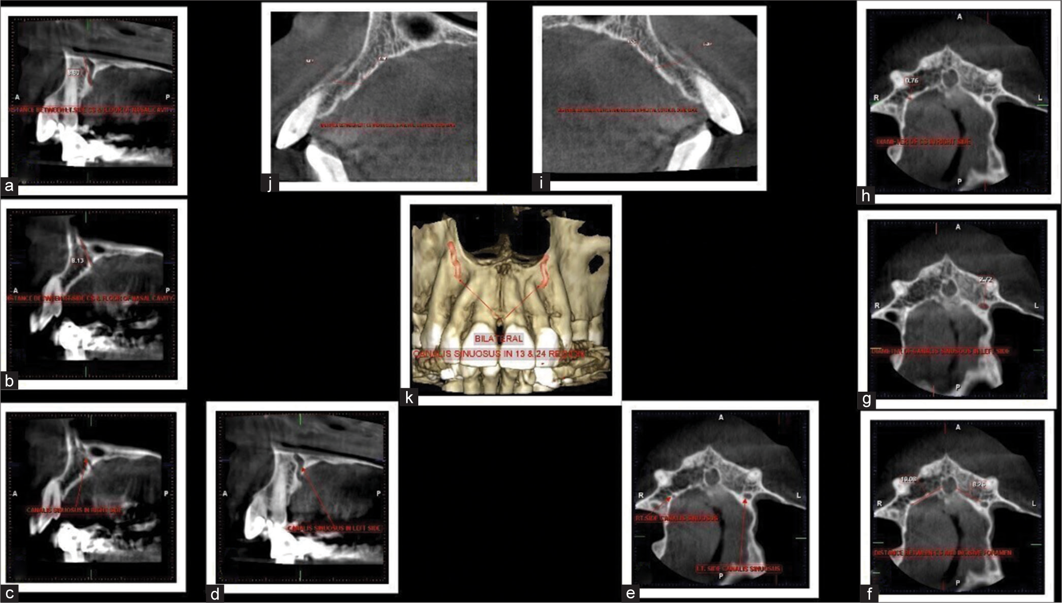 Assessment of canalis sinuosus, rare anatomical structure using cone-beam computed tomography: A prospective study