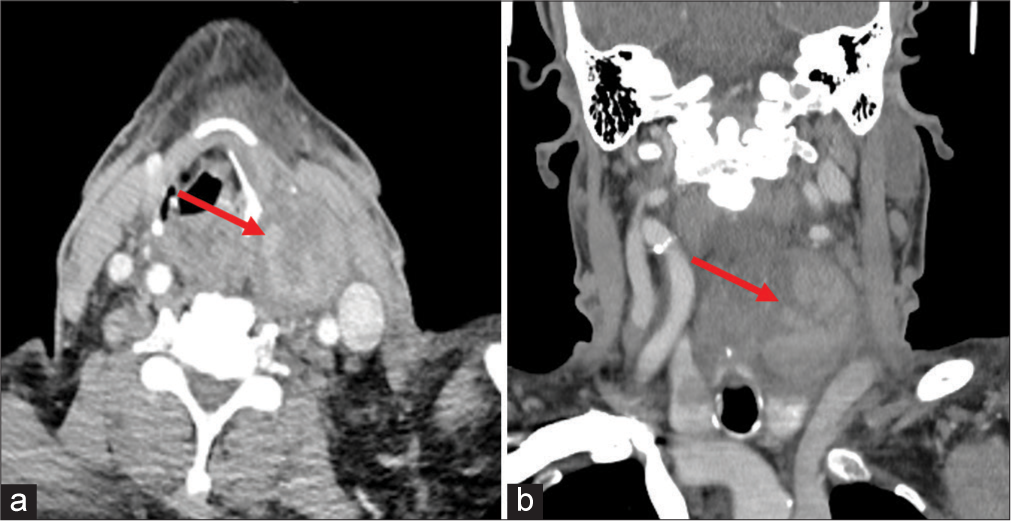 Imaging features and surgical management of giant parathyroid adenoma with autoinfarction