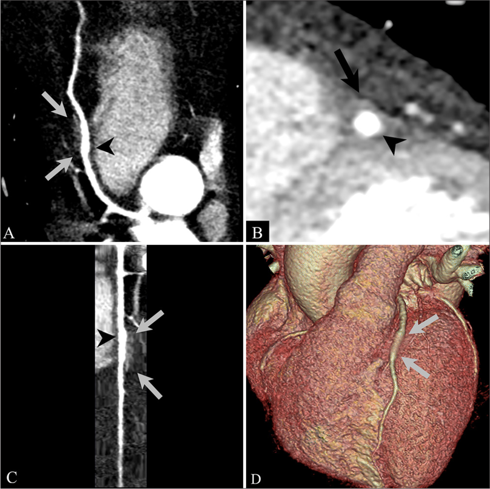 Novel case of coronary artery ectasia and myocardial bridging in one segment detected by coronary computed tomography angiography