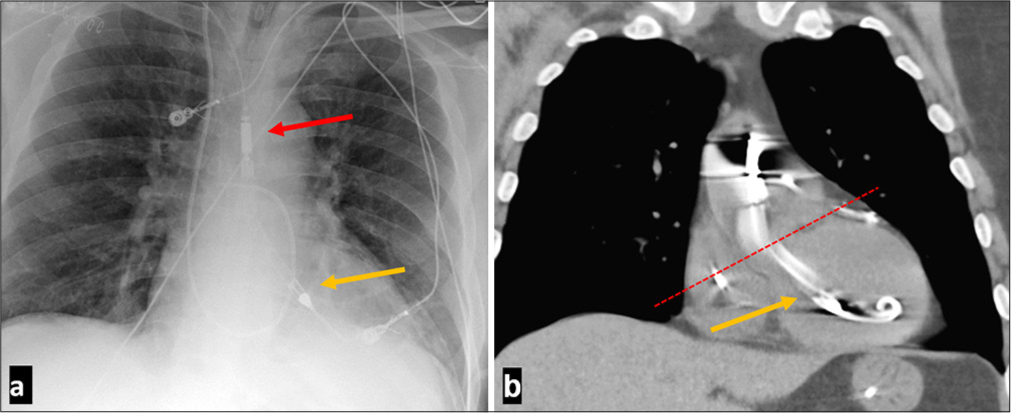 Role of computed tomography and chest radiography in imaging of Impella heart pump and associated complications