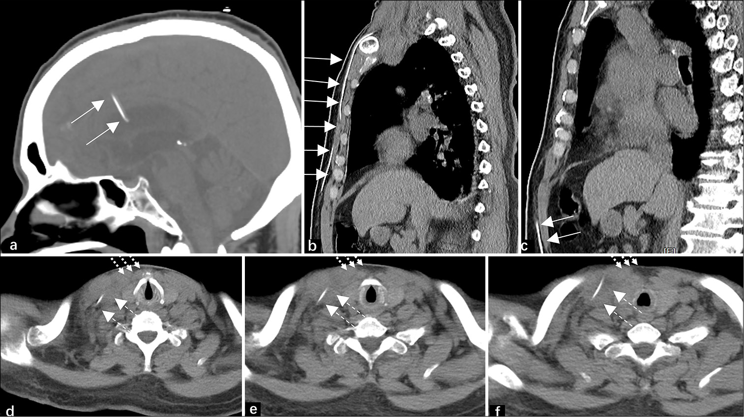Ventriculoperitoneal shunt catheter migration to the pulmonary artery: A rare case report