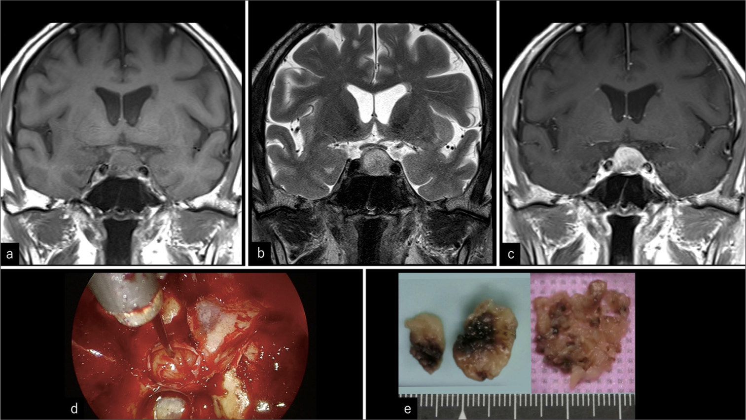 Incidental paraganglioma of sella : A case report and literature review