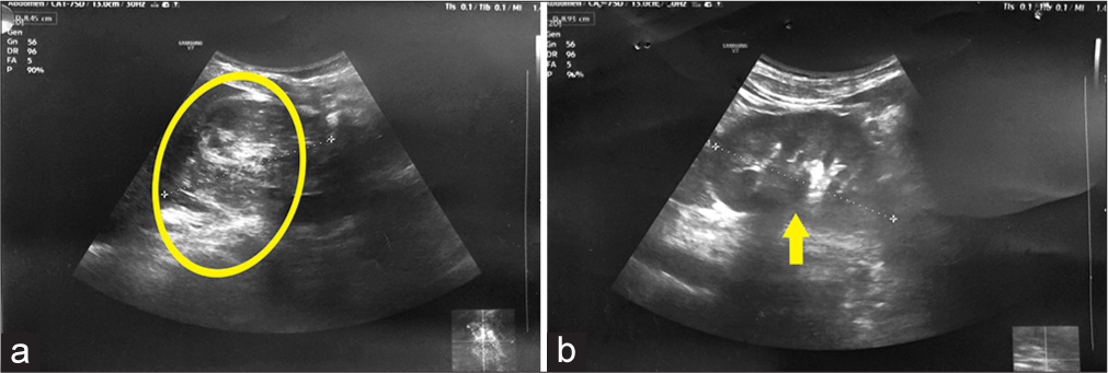 Renal replacement lipomatosis as a rare presentation of long-standing nephrolithiasis