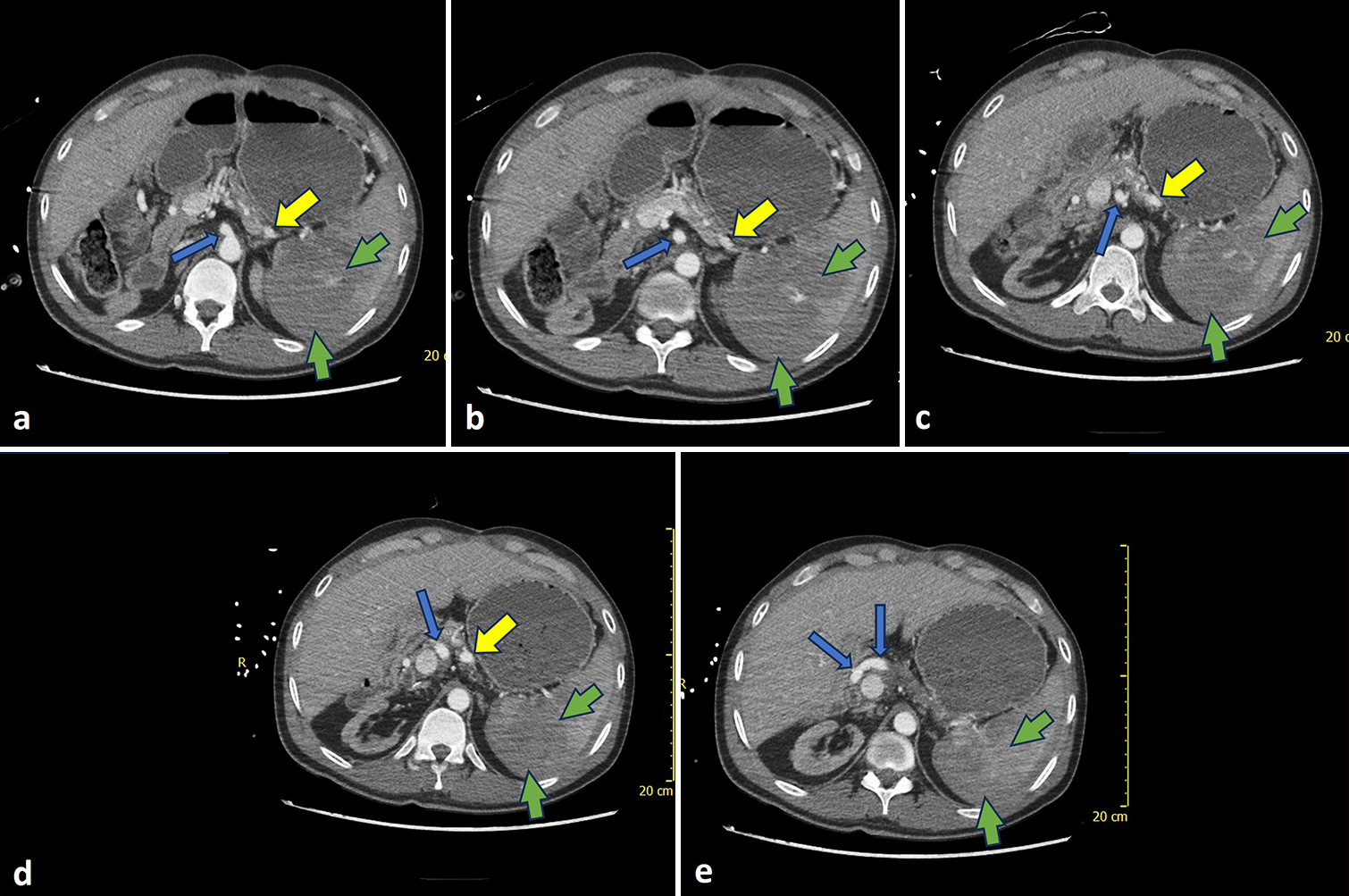 Gastroepiploic artery embolization for splenic trauma in a liver transplant recipient