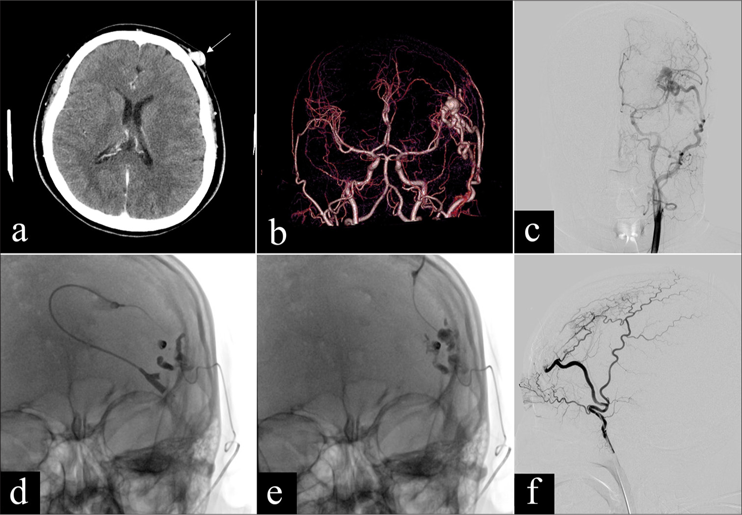 Percutaneous n-butyl cyanoacrylate glue embolization combined with arterial embolization for extracranial arteriovenous malformations