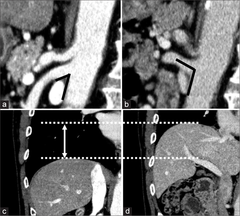 Aortomesenteric angle: A contrast-enhanced computed tomography analysis of respiratory phase and visceral fat impact