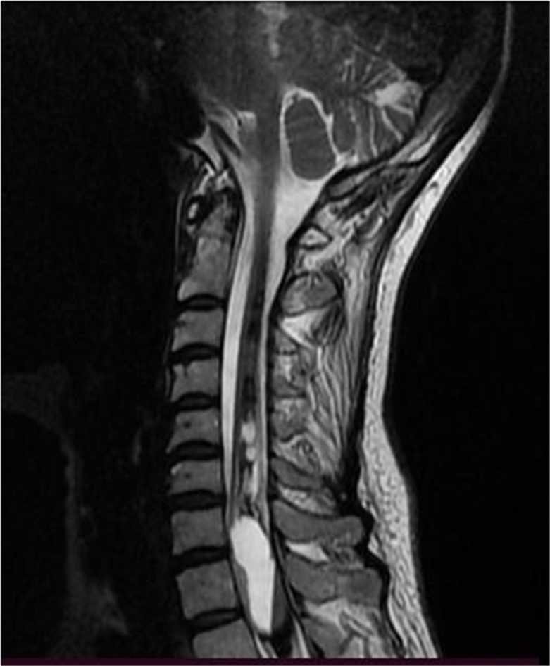Partially calcified giant hemorrhagic syringomyelia and hematomyelia