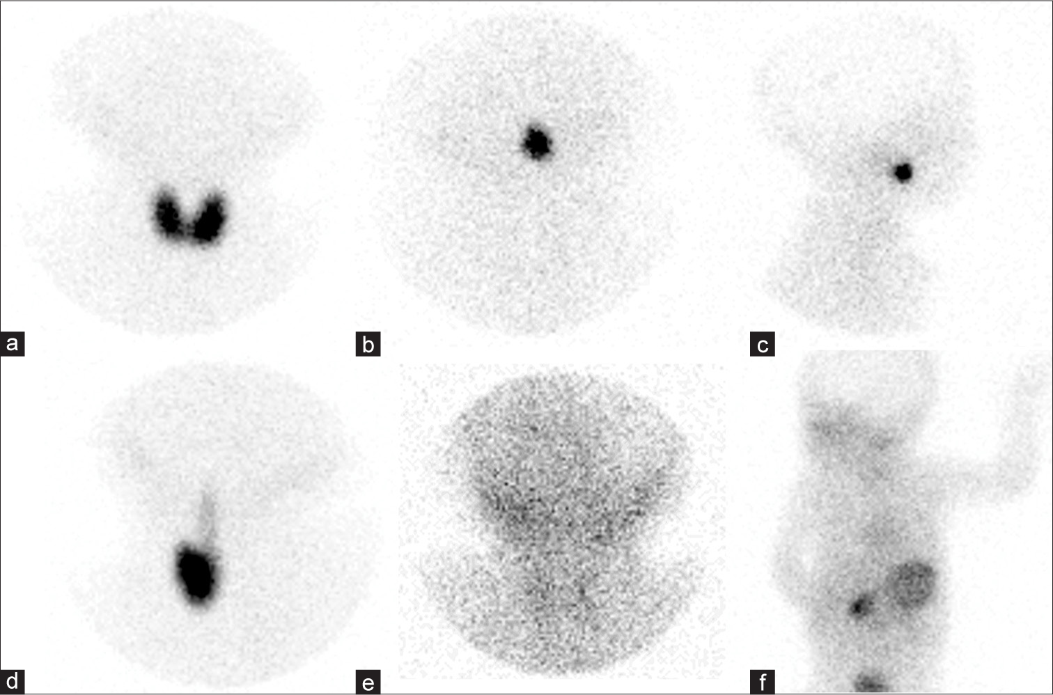 Predictive value of technetium-99m sodium pertechnetate thyroid scintigraphy in determining the permanence of congenital hypothyroidism