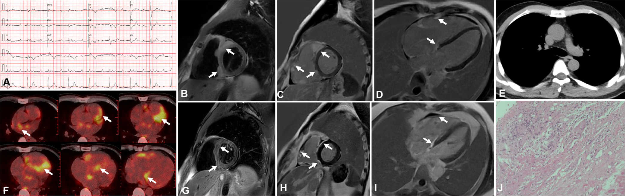 Multimodality imaging in cardiac sarcoidosis: A case series of diverse phenotypes