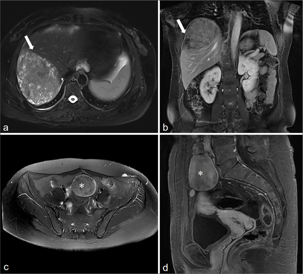 Computed tomography and magnetic resonance imaging features of abdominal and pelvic leiomyomatosis peritonealis disseminata: A retrospective observational study