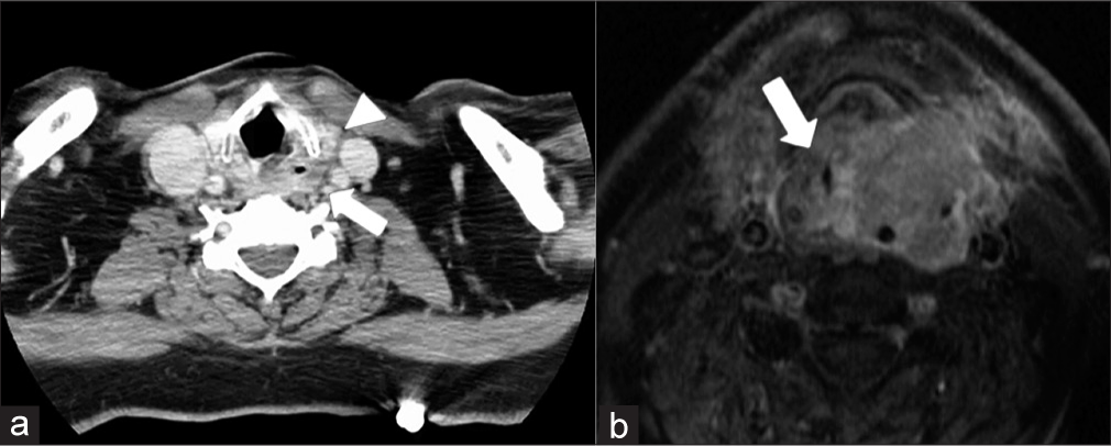 The imaging presentation of head and neck oncologic emergencies