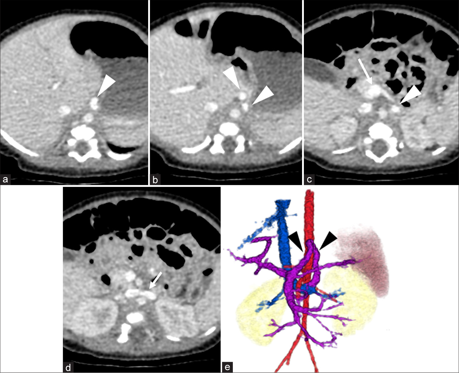 Long-term follow-up and transcatheter embolization of extrahepatic congenital portosystemic shunt with shifting hemodynamics