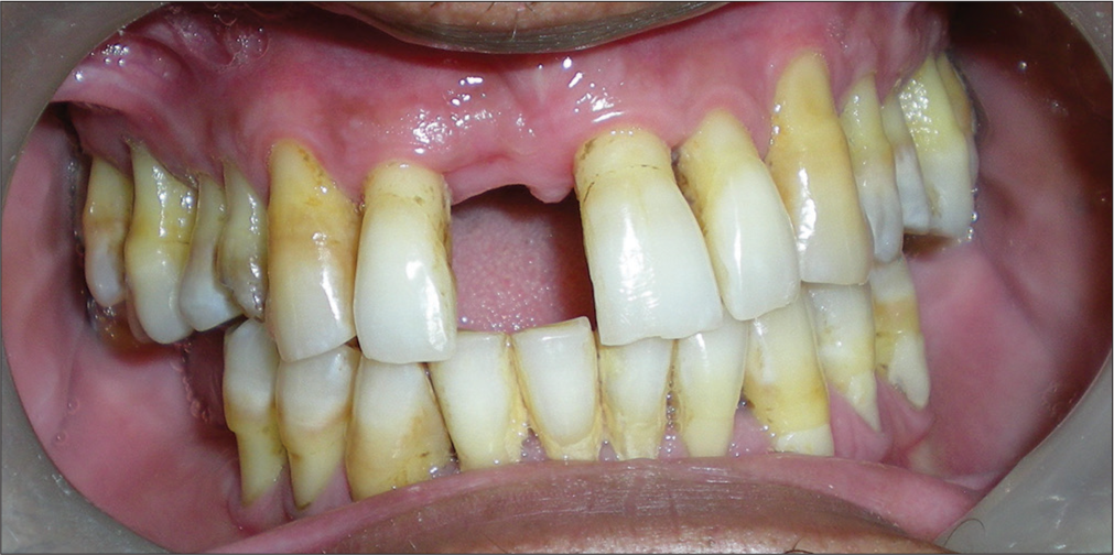 Options for replacing a single lost anterior tooth in a dentition with reduced periodontal health