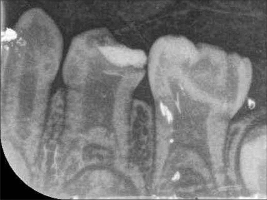 Taurodontism in primary molars: A case report