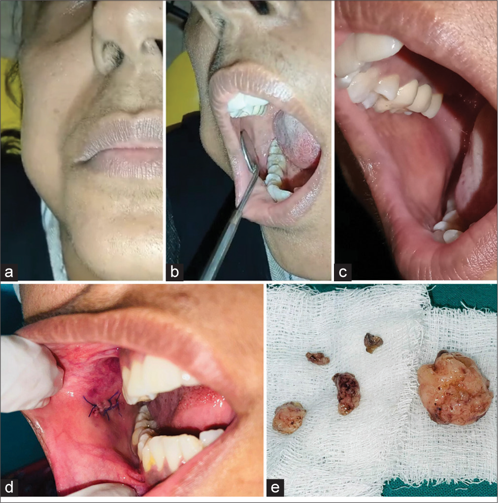 Oral angioleiomyoma – A case report and its diagnostic challenges