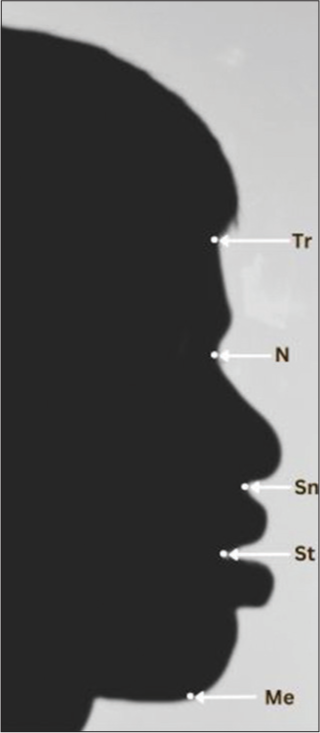 To evaluate the divine proportion on silhouette photographs of skeletal class I bimaxillary protrusion cases treated with first premolar extraction- An in-vitro study