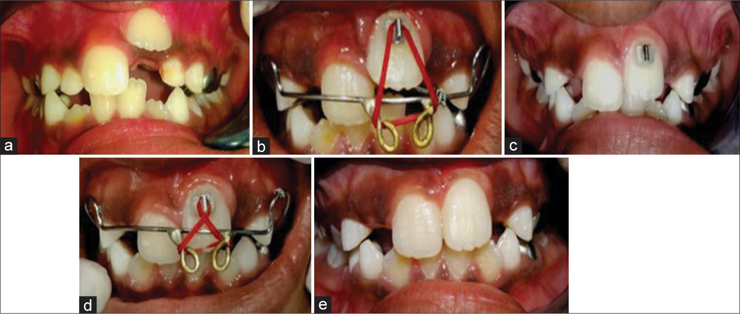 Trauma-induced ectopic eruption: A novel approach – A case report with review of literature