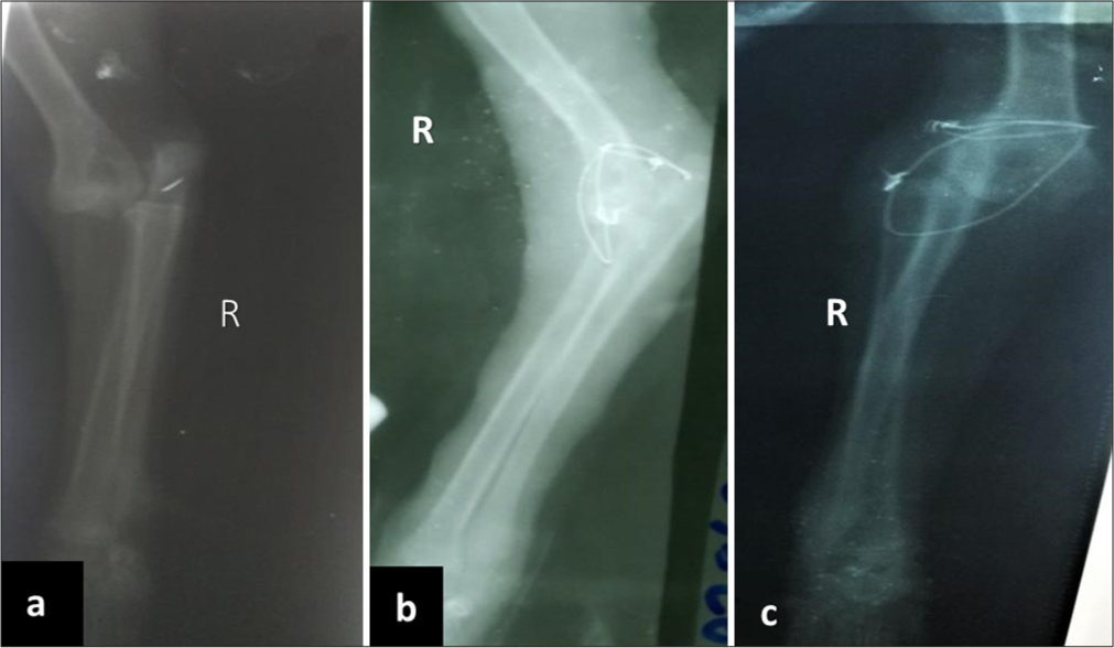Management of Cubital Joint Re-luxation Using a Definitive Approach of Transarticular External Skeletal Fixator