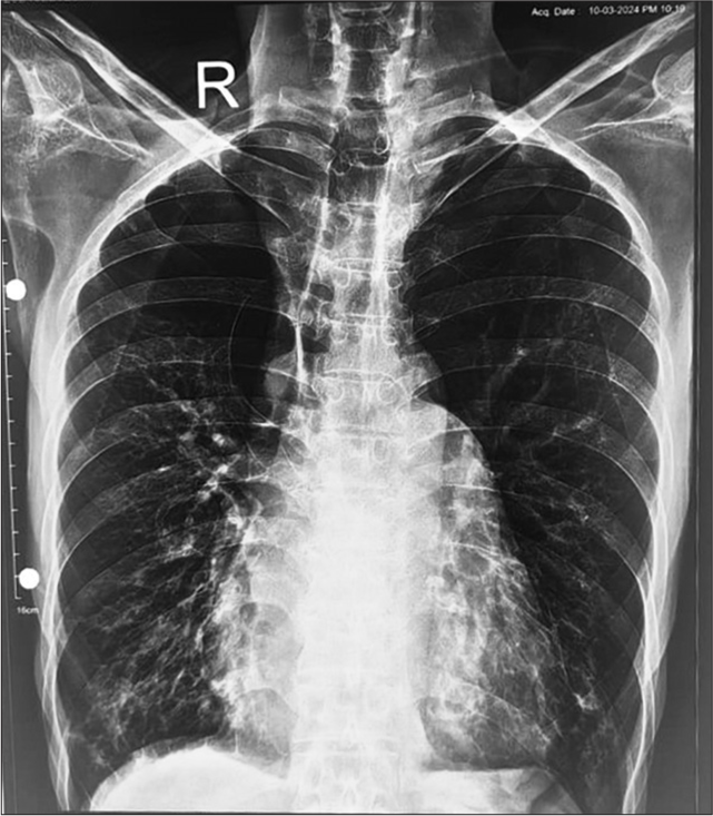 Multivalvular prolapse: A case report of concurrent mitral, aortic, and tricuspid valve involvement in the same patient with severe regurgitation and heart failure features