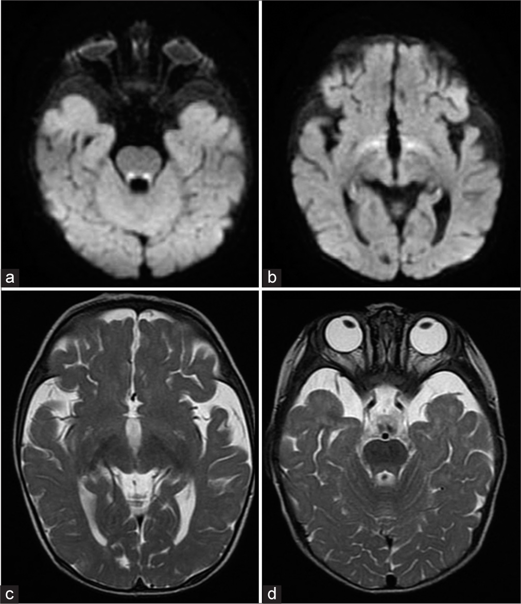 West Syndrome due to ALG13 mutation presenting vigabatrin-associated reversible MRI signal changes and drug-induced dyskinesia