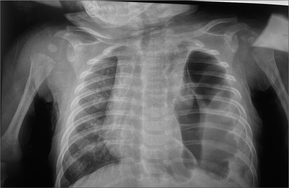 Intriguing presentation of congenital diaphragmatic hernia