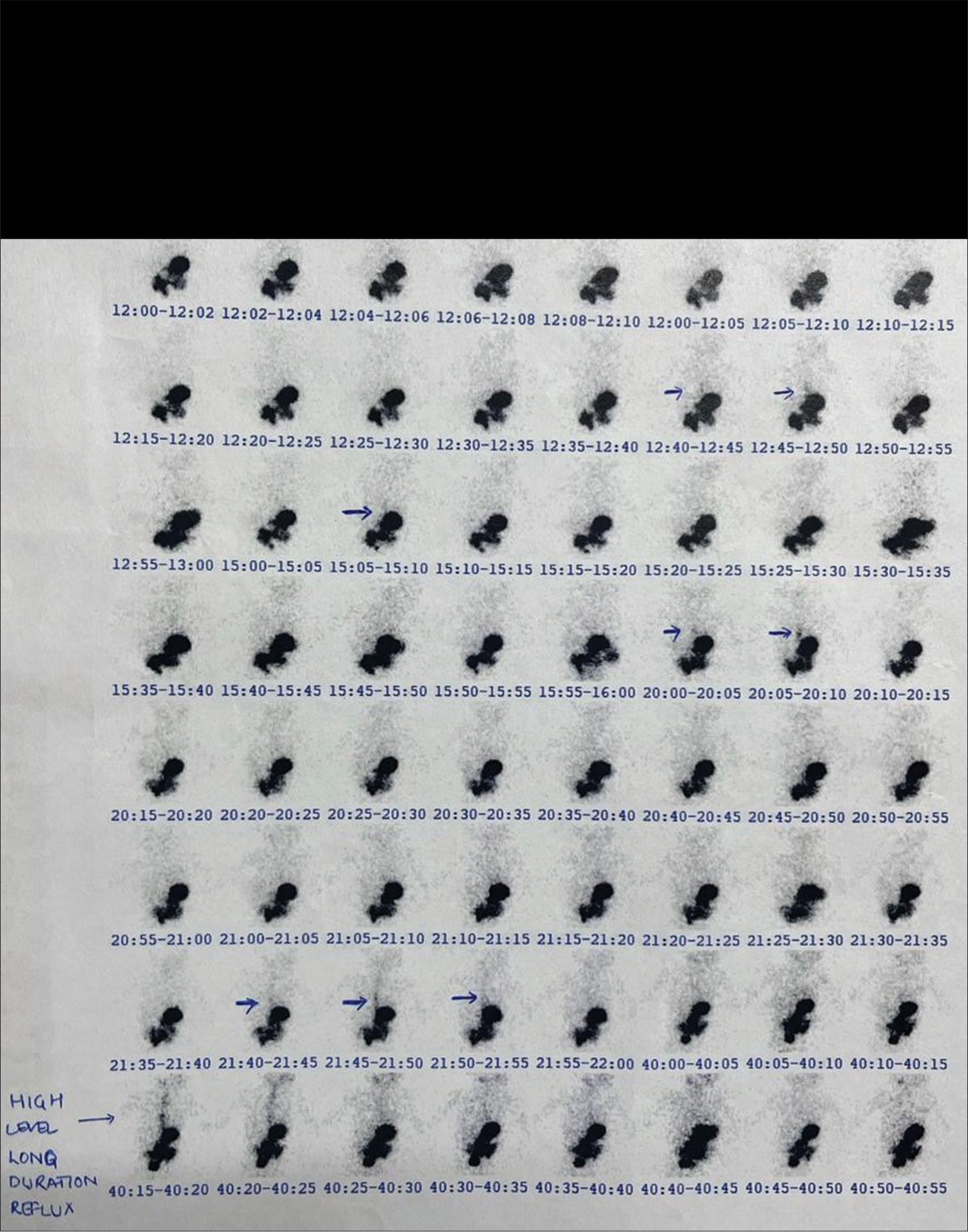 Lentil hypersensitivity pneumonitis as a masquerader in an infant with recurrent pneumonia