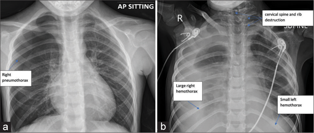 Pediatric pulmonary Langerhans cell histiocytosis complicated by recurrent hemopneumothoraces