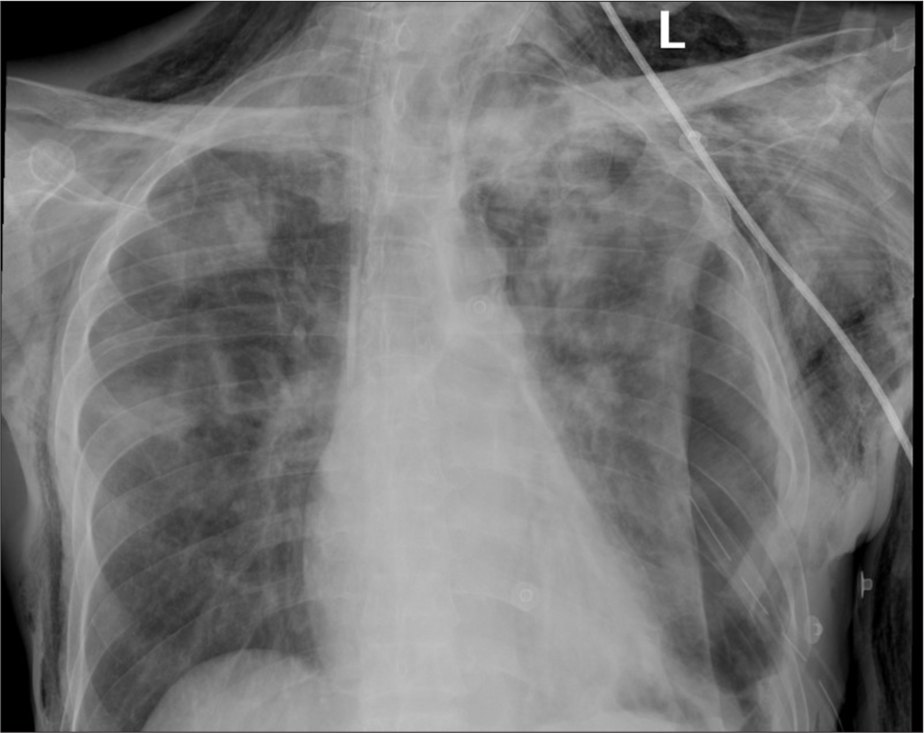 Bronchoscopic spigot occlusion of tuberculosis-associated bronchopleural fistula in a human immunodeficiency virus-positive high-risk patient