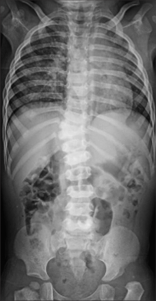 “H” type tracheoesophageal fistula associated with cardiac and vertebral defects: management challenges at our institute – A case report with literature review