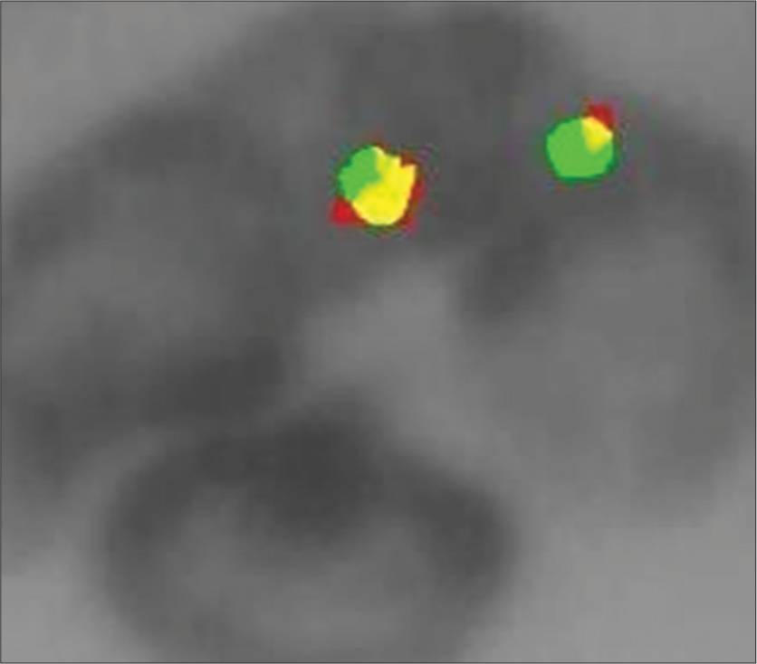 Frequency of t(11;22)(q24;q12) in Ewing’s Sarcoma using Fluorescence in Situ Hybridisation Technique