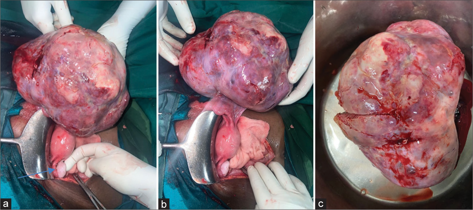 Pregnancy and Unilateral Krukenberg Tumour: Factual or Fictious – A Case Report