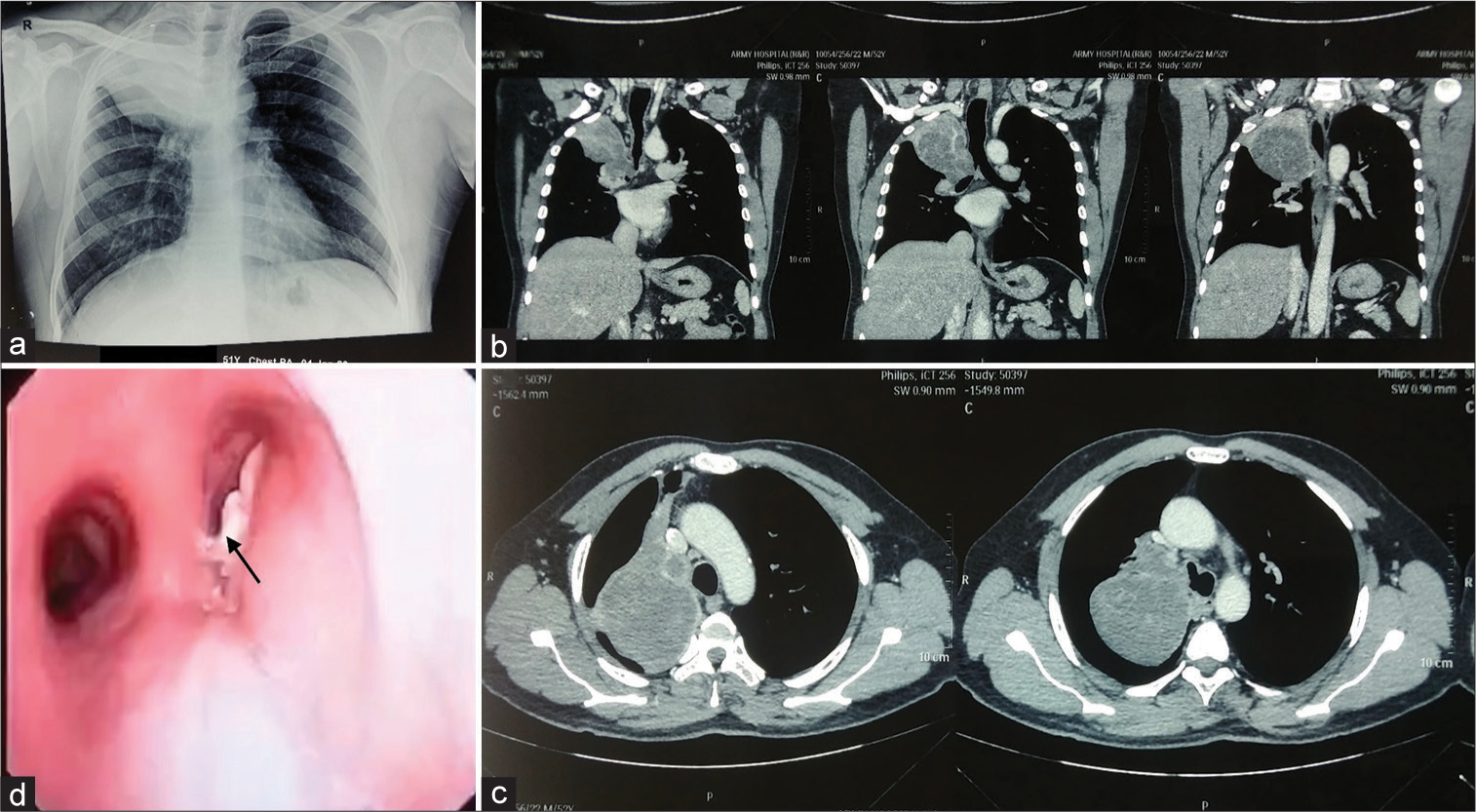 Primary Endobronchial Conventional Chondrosarcoma Right Lung Upper Lobe: A Case Report and Literature Review