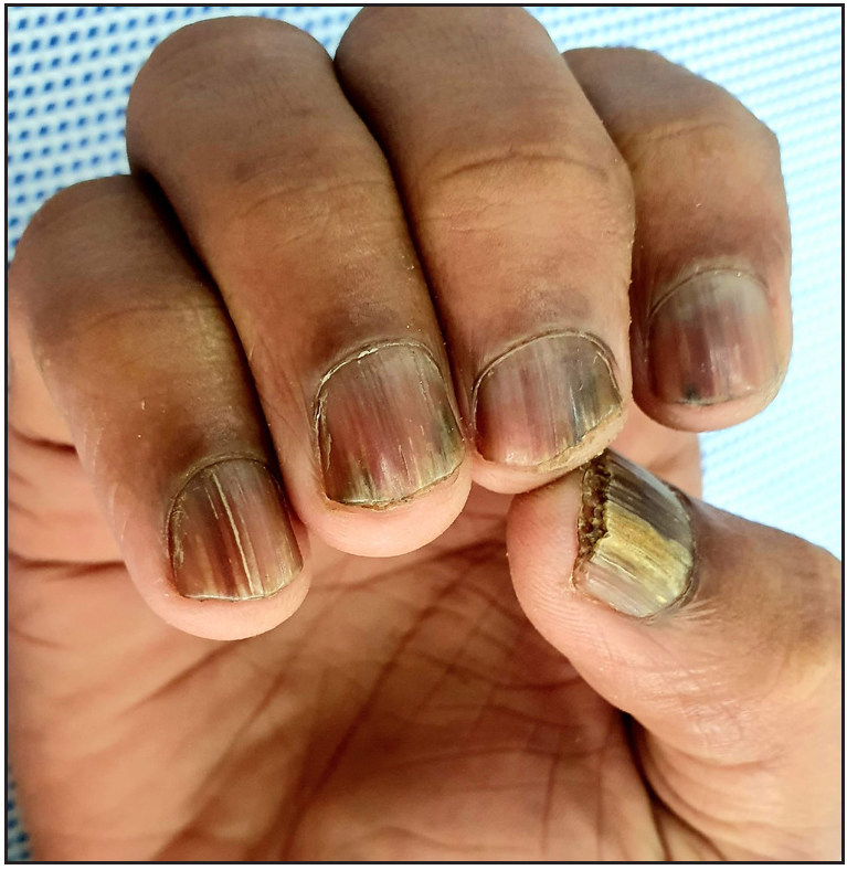 Clinical characteristics and management outcomes in isolated nail lichen planus: A retrospective case series