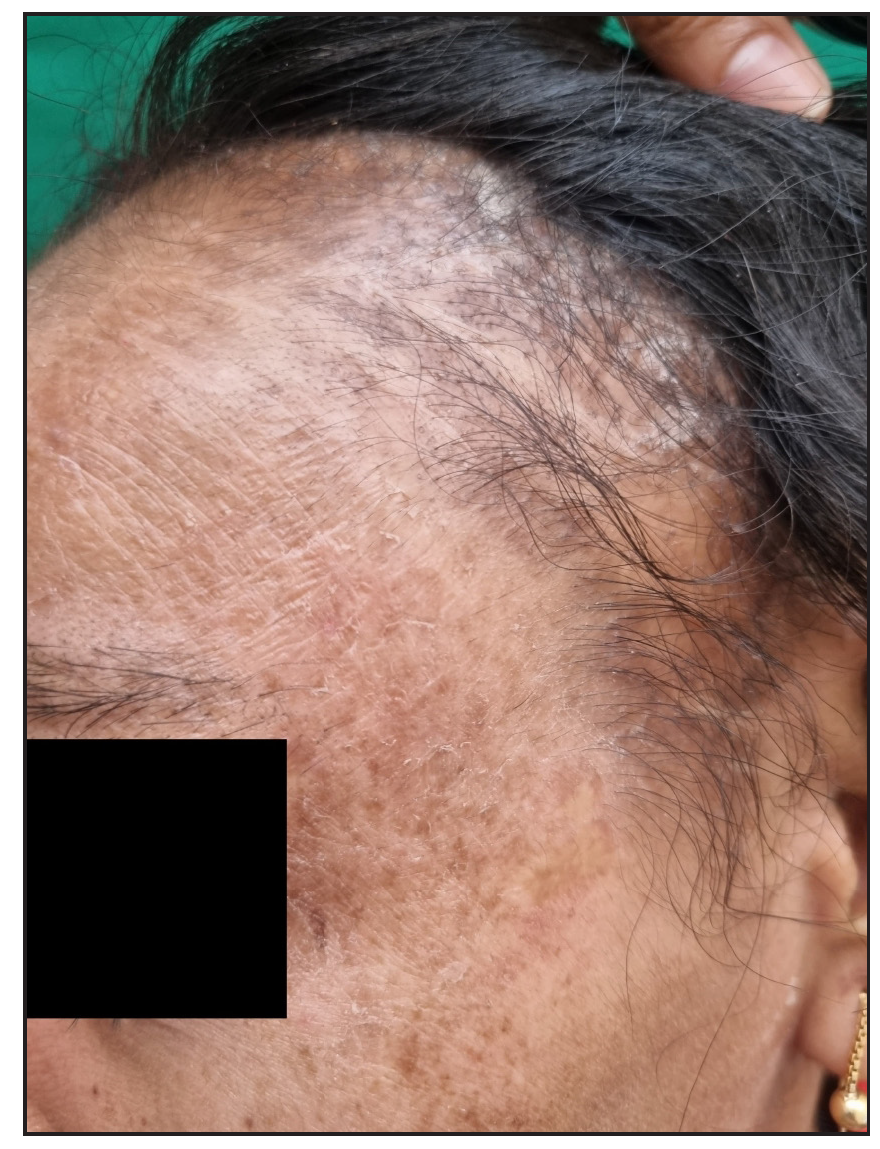 Patterned cicatricial alopecia in two sisters with lamellar ichthyosis