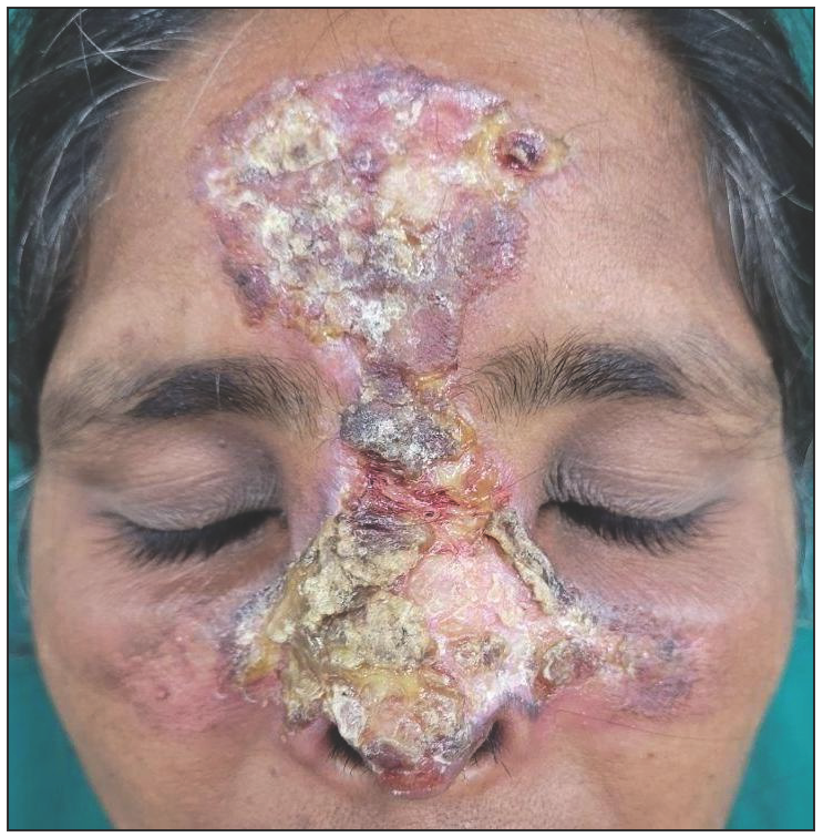 Discoid lupus erythematosus presenting as an unusual giant plaque on face