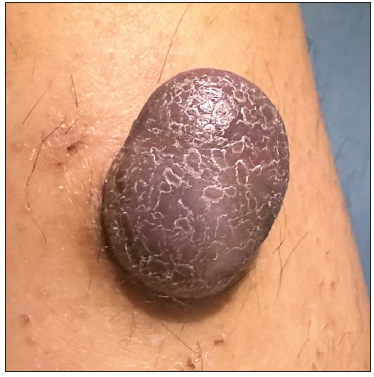 Giant purplish tumour on the leg of a healthy woman