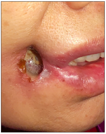 Oral cutaneous fistula associated with intestinal Behçet’s disease and mucous membrane pemphigoid: A case report