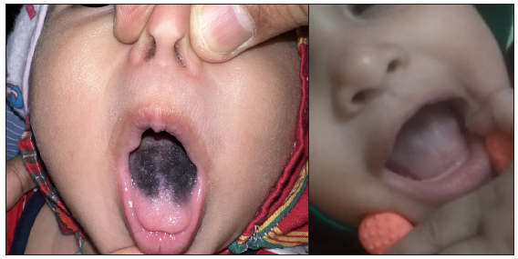 Lingua villosa nigra in an infant