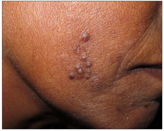 Agminated pigmented papules on the face: A rare presentation of neurofibroma