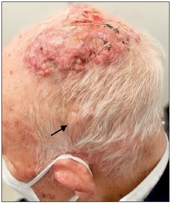 Spontaneous regression of aggressive cutaneous squamous cell carcinoma