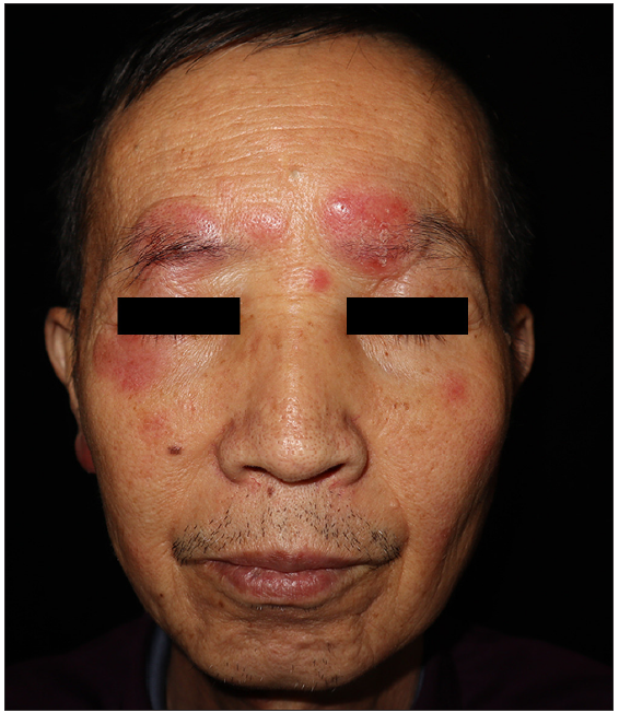 Dermoscopic features of primary cutaneous extranodal natural killer (NK)/T-cell lymphoma