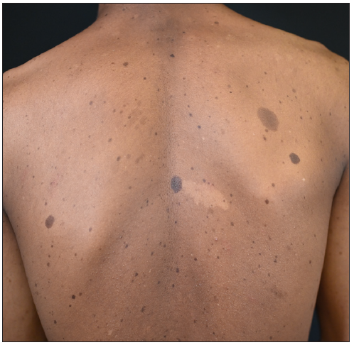 A novel KITLG mutation causes familial progressive hyperpigmentation and hypopigmentation with multiple café-au-lait macules