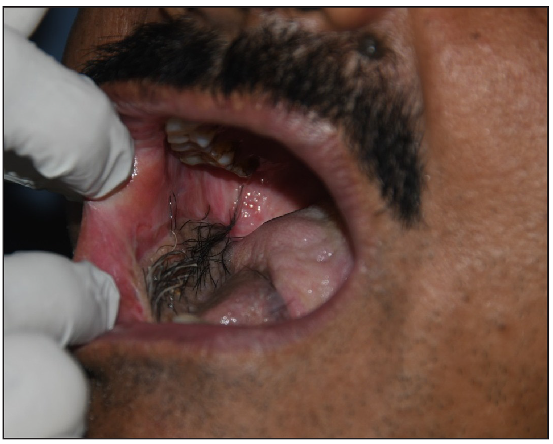 Combined approach for intra-oral paratrichosis using electro-epilation and long pulsed NdYAG laser