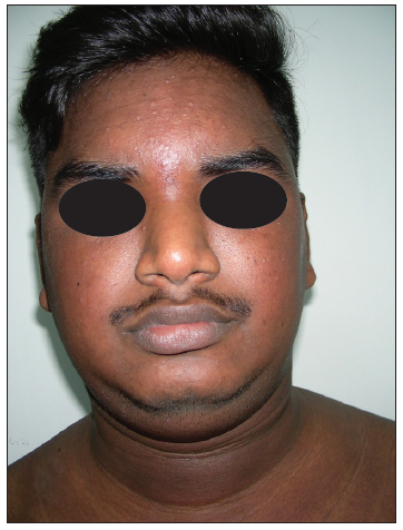 An unusual case of benign cutaneous lymphoid hyperplasia masquerading as diffuse Addisonian-like pigmentation with skin infiltration – An atypical presentation