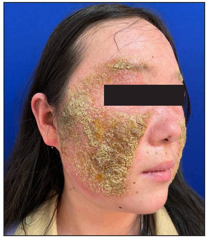 Transcutaneous auricular vagus nerve stimulation treatment for cutaneous dirt-adherent disease complicated with rosacea