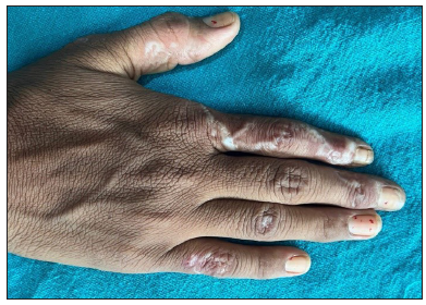 Serpentine and annular presentation of extragenital lichen sclerosus-morphea overlap