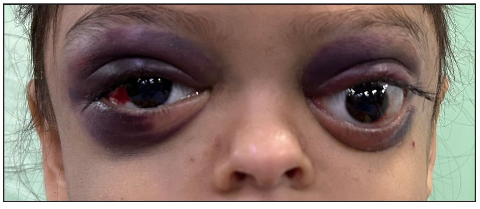 Raccoon eye: An ocular presentation in metastatic neuroblastoma