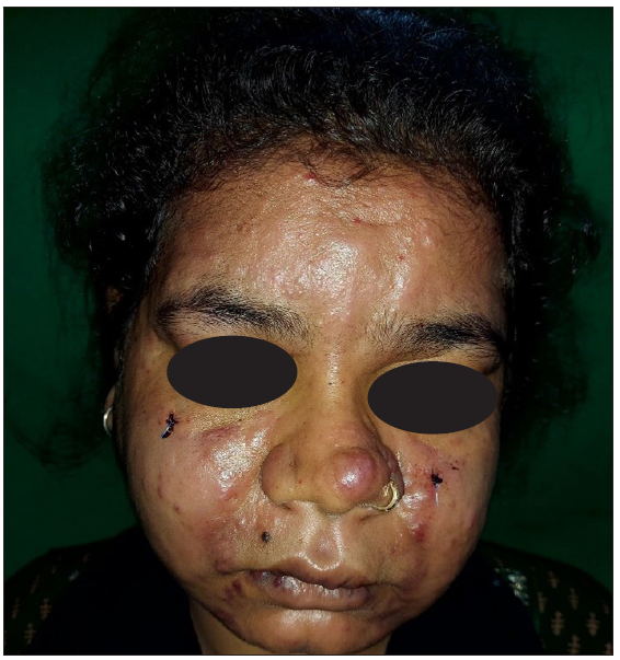 Cutaneous myeloid sarcoma- Deciphering clinical clues