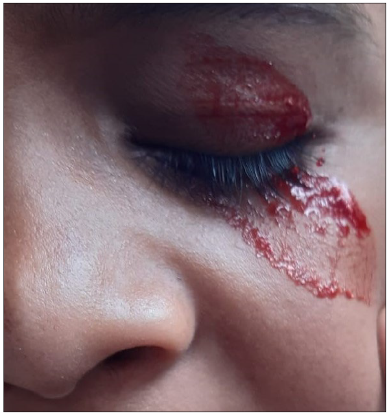 A child’s cry: Hematohidrosis - Unmasked by surgical trauma