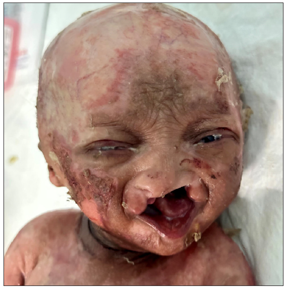 A de novo case of ankyloblepharon, ectodermal defects, cleft lip/palate syndrome with TP63 mutation diagnosed prenatally